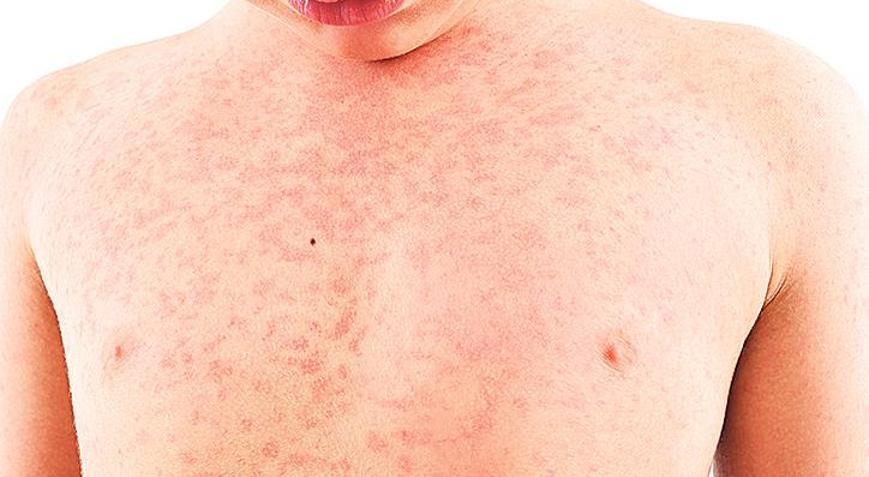 İstanbul’da kızamık tehlikesi: Aşı yaptırın