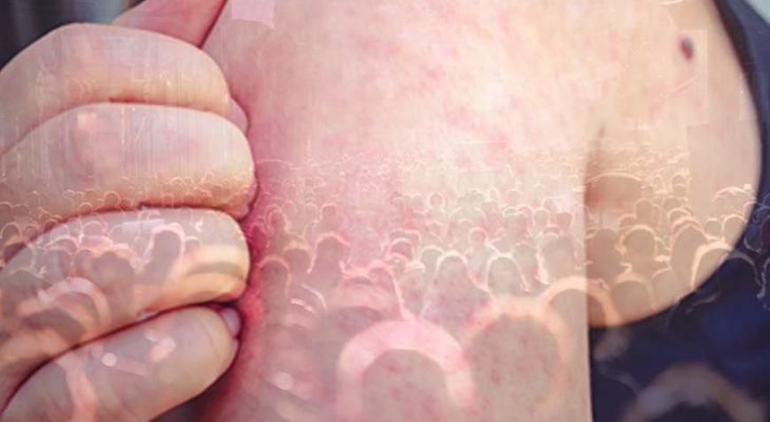 Yaşları 25, 30, 35... Grip sandı, kızamık çıktı Kritik sınır 1998, ölüme götürebilir