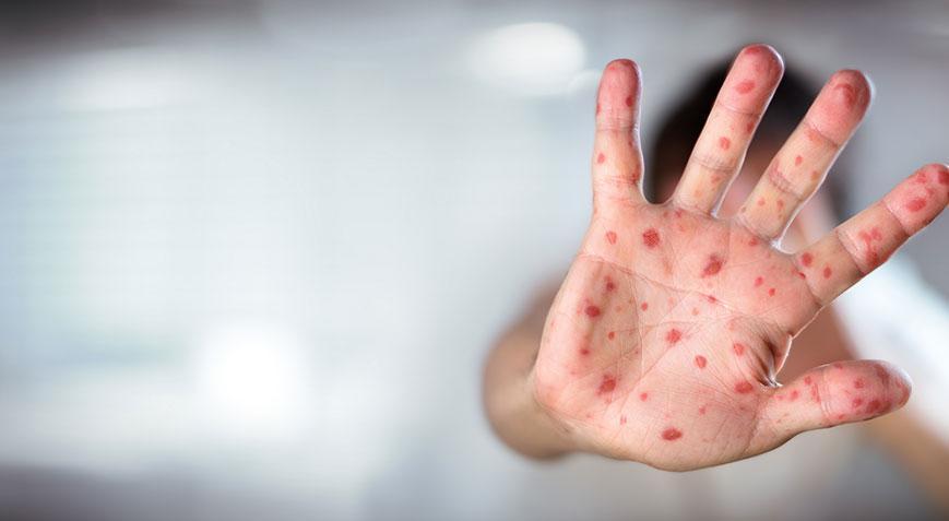 Kızamık tehlikesi devam ediyor Uzman isim artışın sebebini açıkladı