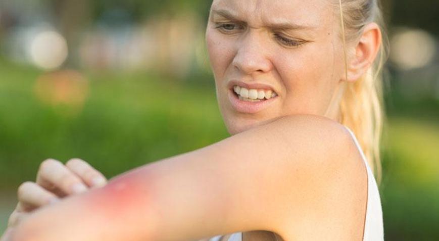 Yaz alerjisi deyip geçmeyin İçlerinde ölüme kadar götüren bile var