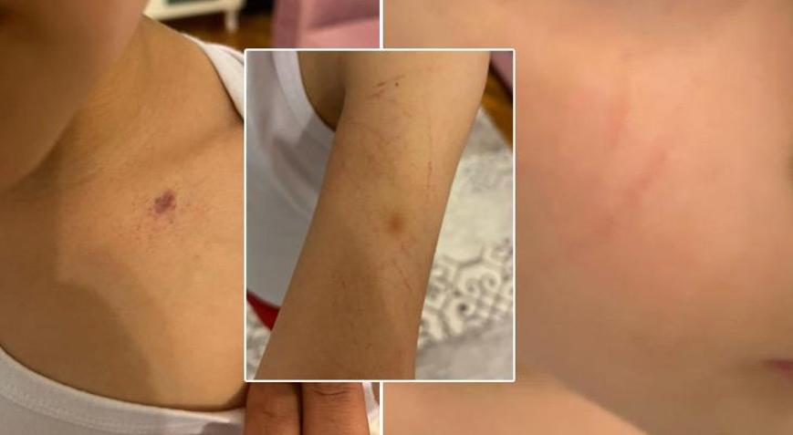 Anaokulunda öğretmenden rezalet Çocuğunda morluklar görünce şoke oldu