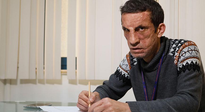 Türkiyenin ilk yüz nakillisi Uğur Acar, üniversiteye hazırlanıyor