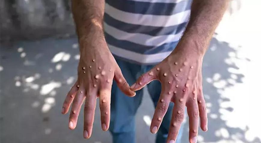 Pakistan’da ilk maymun çiçeği vakası görüldü