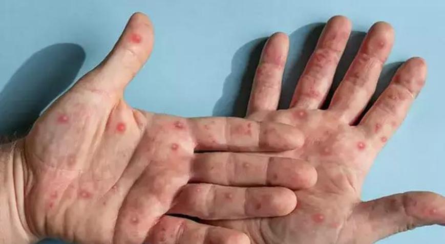 Maymun çiçeği uyarısı: Çocuklar daha kolay bulaş kaynağına maruz kalabilir