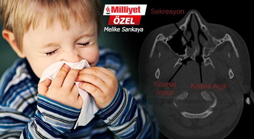 Bitmeyen burun akıntısının sebebi koanal atrezi olabilir 8 bin doğumda bir görülüyor