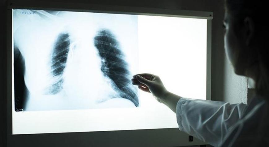 Dünya Sağlık Örgütü, 2023 yılı tüberküloz verilerini açıkladı