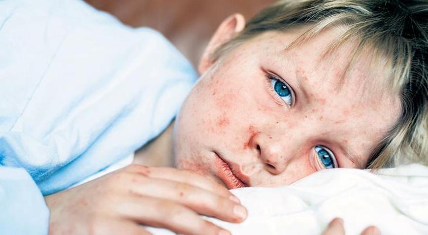 Dünyada kızamık alarmı 10 milyonu aştı...