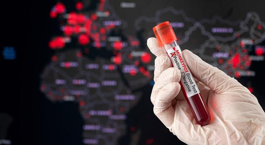 Fransada M çiçeği alarmı  Virüsünün yeni varyantı ilk kez tespit edildi