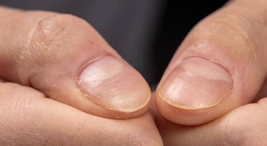 Biotin eksikliği böyle anlaşılıyor Tırnaklarınızdaki bu detaya dikkat edin