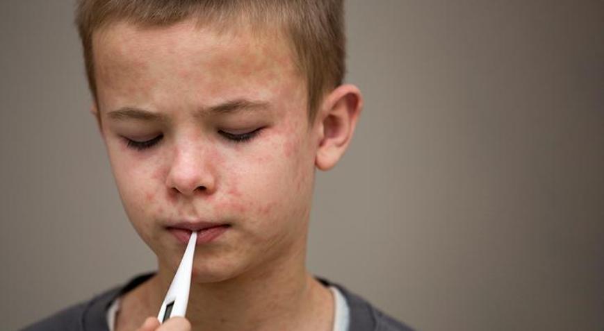 Avrupada kızamık vakaları 2024te neredeyse on kat arttı