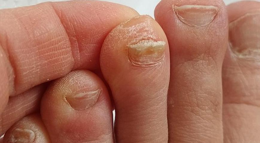 Tırnak mantarını tedavisi sabır gerektiriyor Önlemenin yolu bu çoraplardan geçiyor