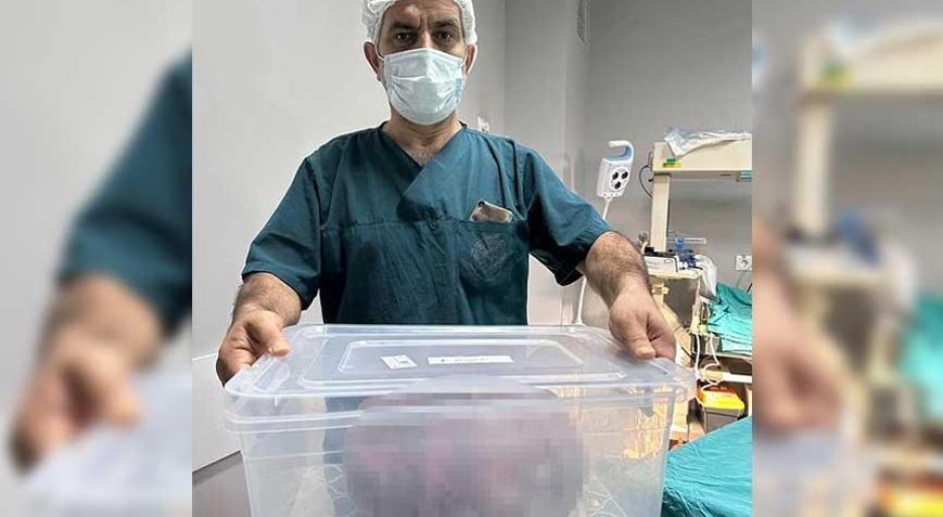 Ameliyat masasında büyük şok 9 kilo ağırlığında kile çıkartıldı