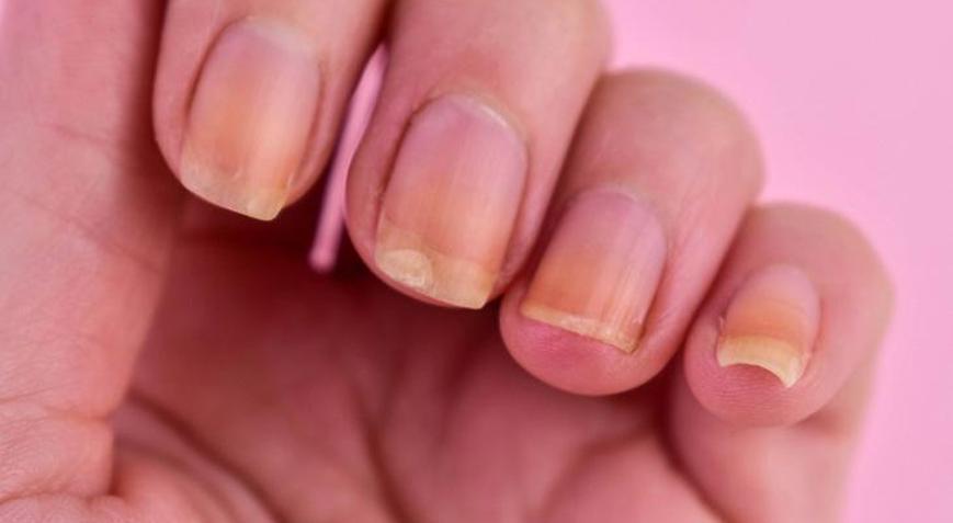 Tırnak sararmalarına birebir Hem güçlendiriyor hem de sağlıklı uzatıyor