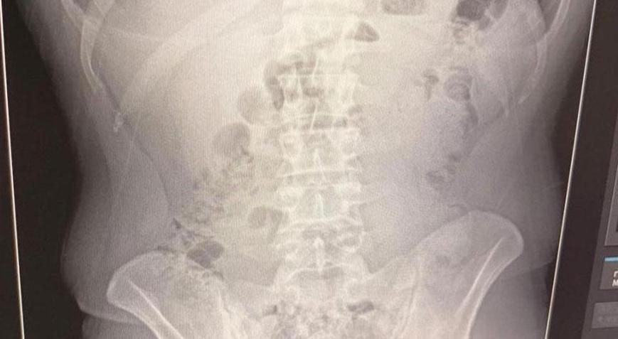 Midelerinden uyuşturucu çıktı: İranlı 3 kişi tutuklandı