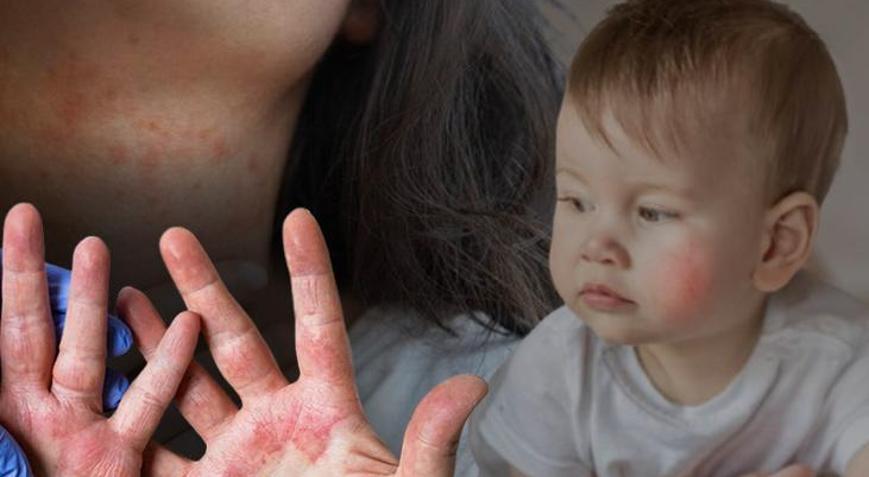 Türkiye de listede, tüm hayatı kötü etkiliyor Sıradan alerji değil: Kaşıdıkça çoğalır