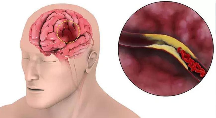 Sağlık Bakanlığı uyardı İşte inme belirtileri ve yapılması gerekenler