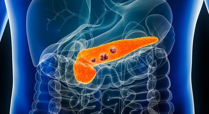 Pankreas kanserinde umutları artıran gelişmeler: Sağ kalım oranı yüzde 54e yükseldi