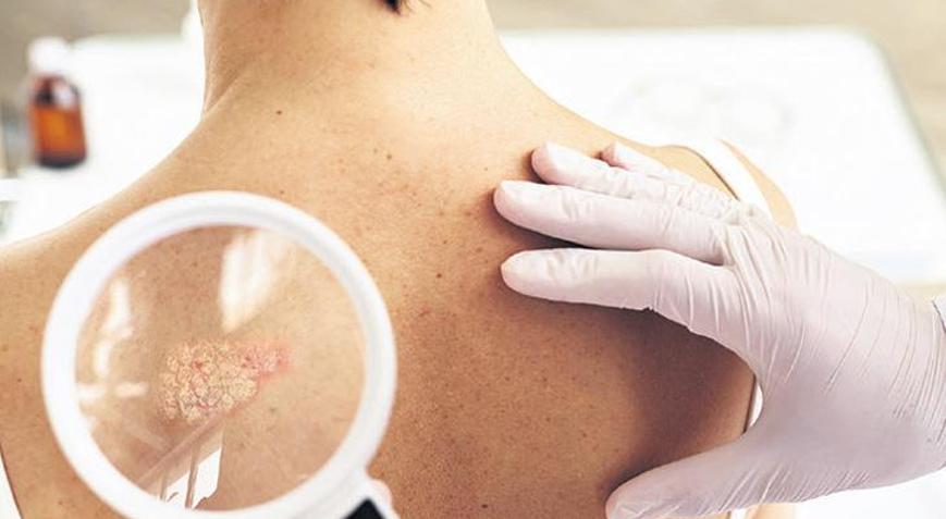 ‘Sedef’ zengin hastalığı mı