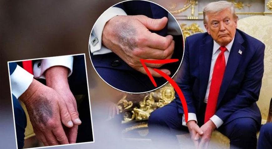 Trump elindeki morlukların sebebini açıkladı Çeşitli söylentiler vardı