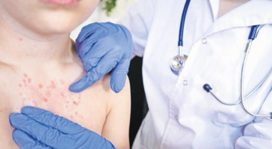 Geri mi dönüyor Su çiçeği vakalarında artış