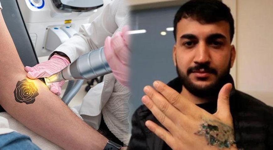 Dövme sildirecekti kabusu oldu: Deri ve doku nakli yapılacak Herkes ve her dövme uygun değil