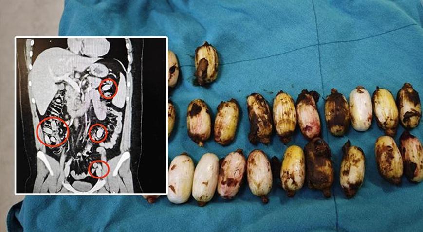 44 kapsül bonzaiyi midesinde saklamış Cerrahi müdahale ile çıkarıldı