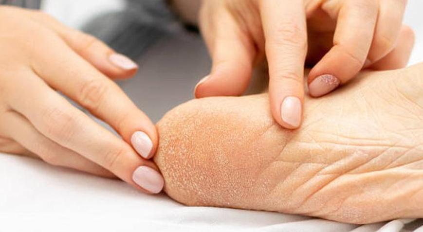 Pedikür salonlarını unutun: Evde topuk çatlaklarını bebek cildi gibi yapan doğal kür