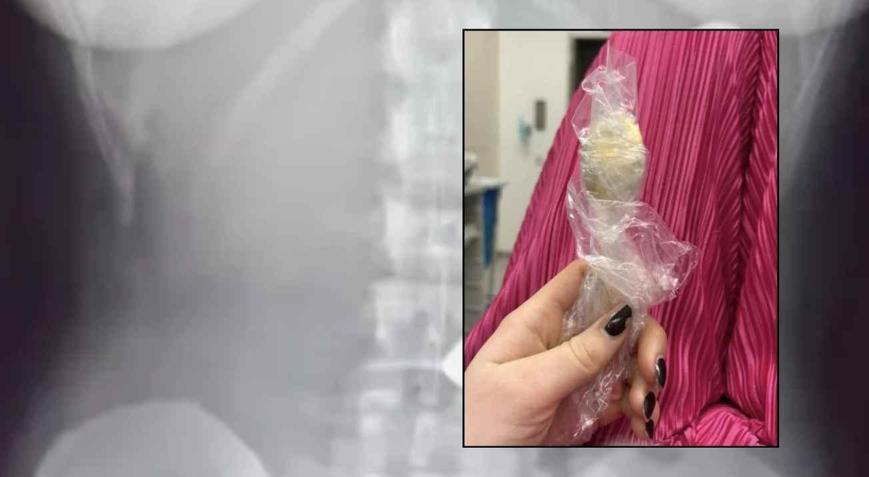 Yoğurt yerken bir anda oldu, söylemeye dahi utandı Tam 17 santimetre büyüklüğünde, 2 gün vücudunda kaldı