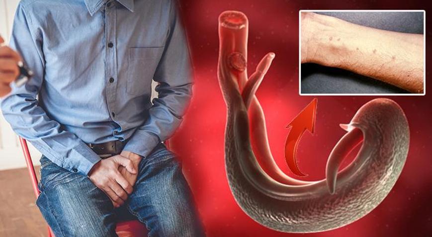 Yeni küresel tehdit: Melez şiştozomiyaz Cinsel organlara yerleşip kısırlığa yol açıyor