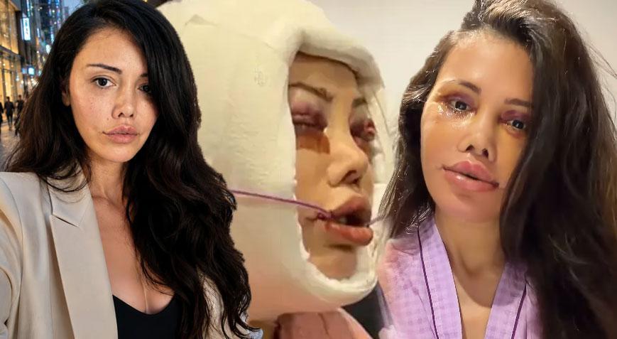 Didem Ceran 15 saatlik operasyonla yüz nakli olmuştu Kendisini dünyaca ünlü yıldızla karşılaştırdı