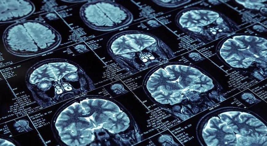 45 yaş üstü dikkat Ezber bozan araştırma: 3 basit alışkanlık demansı 13 yıl geciktirebilir
